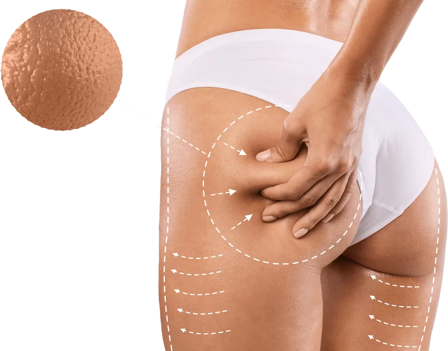 Treatment pattern drawn over the back of the thigh and hip, with a close-up of skin texture